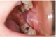 歯ぎしりの症例